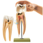 Molar with Caries Model